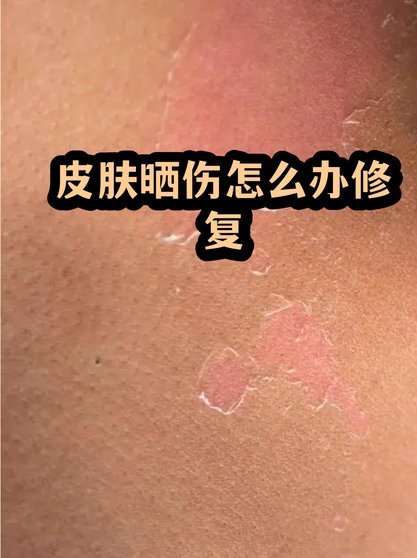 赖斯晒伤定妆照红得发亮，妈妈怒